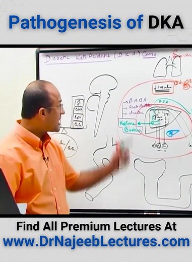 Pathogenesis Of DKA. Reduced insulin concentration or action, along with increased insulin counter-regulatory hormones, leads to the hyperglycemia, volume depletion, and electrolyte imbalance that underlie the pathophysiology of DKA. | Dr. Najeeb