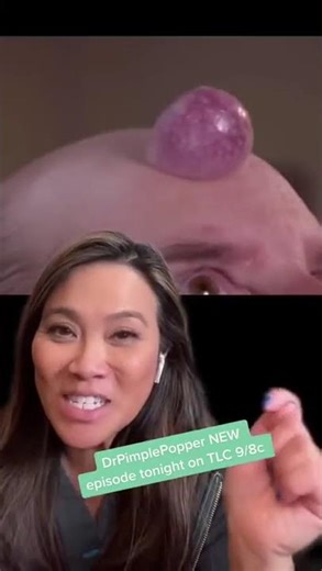 Dr Pimple Popper Explains Forehead Growth!