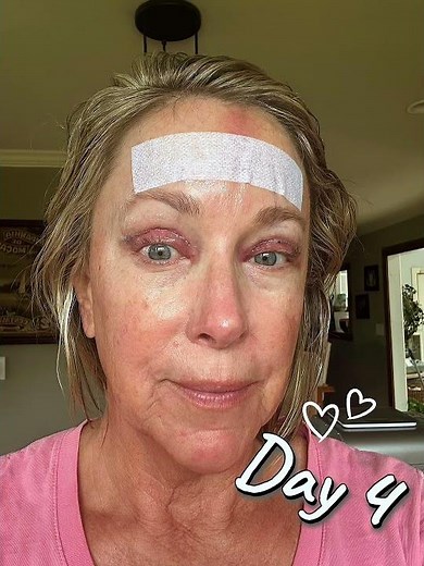 Upper Blepharoplasty & Endoscopic Brow Lift: My Real Experience, Recovery & Results