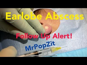 FOLLOW UP ALERT! 4 weeks post abscess drainage on earlobe. Healing spectacularly. Happy patient!