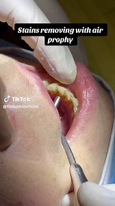 Effective Stains Removal with Air Prophy