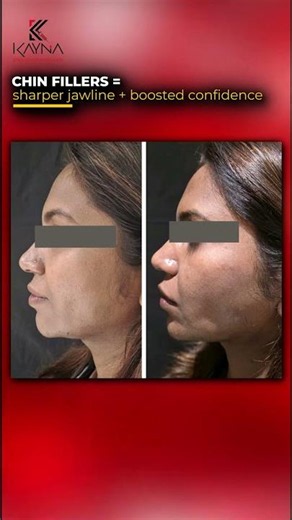 Chin Fillers Before & After | Get a Defined Jawline & Enhanced Profile Without Surgery