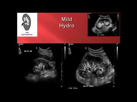 Hydronephrosis Point of Care Ultrasound