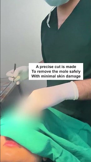 Safe & Painless Mole Removal Surgery | Skin Joy Clinic