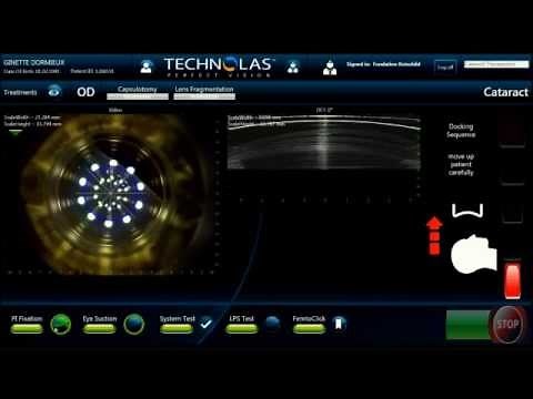 Cataracte opération au laser femtoseconde VICTUS - Dr Damien Gatinel - Fondation Rothschild