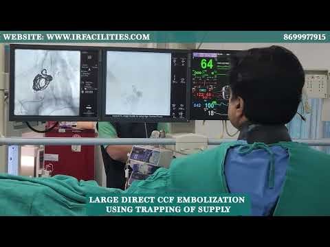 Large Direct CCF Embolization Using Trapping of Supply | Advanced Neuro Interventional Procedure