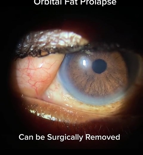 Orbital Fat Prolapse #orbitalfat #eyedoctor #optometrist #nourisheveryyou