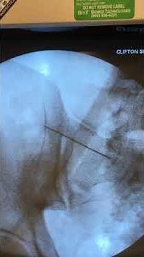 SacroIliac Joint Injection