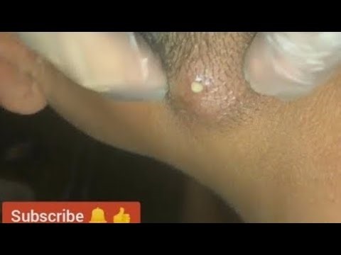 How to pop a giant boil on back, pimple & cyst popping this week, blackheads, zits and acne treatmen