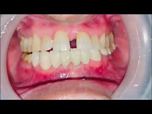 Satisfying Zirconia Bridge Procedure for Beautiful Lower Teeth Replacement | Full Before & After