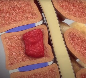 Hemangioma da Coluna Vertebral