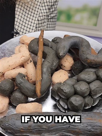 What Does a Pencil Thin Poop Mean? 😯 💩 Are you concerned about the consistency of your stool? Having poop that's too thin can be a sign of an underlying health issue. In this video, Dr. Janine explores the possible reasons behind thin poop and what you can do to achieve a healthier digestive system. Whether it's a dietary change, a medical condition, or a lifestyle adjustment, Dr. Janine covers the essential information you need to know to take control of your bowel health. Watch until the end