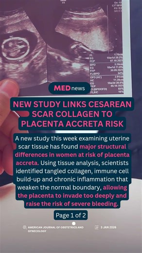 🧬 New study links C-section scar healing to dangerous pregnancy condition #pregnancy #maternalhealth