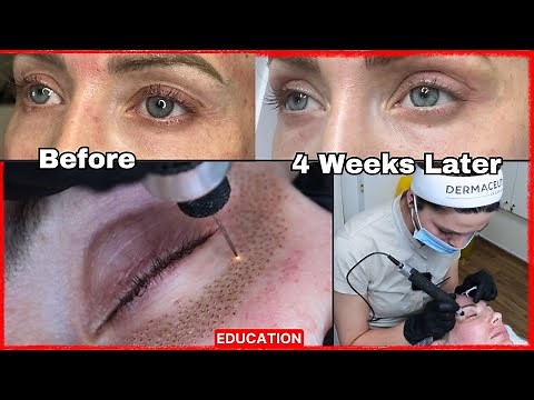 Plasma Pen on Lower Eyelid for Fine Lines and Eye Lifting BEFORE AND AFTER (2024)