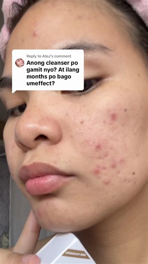 Azelane Soap Review: Effective for Acne-Prone Skin