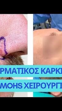 Καρκίνος του Δέρματος - MOHS Χειρουργική #skincancer #mohssurgery #καρκίνοσ