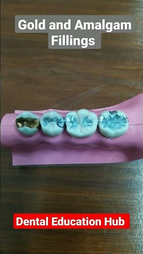Gold and Amalgam Fillings | Dental Materials