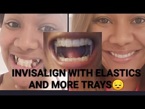 invisalign update #2: how to put elastics (rubber band) with invisalign for overbite