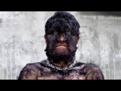 Hypertrichosis, also known as "werewolf syndrome"!