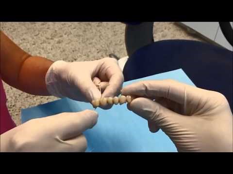 How to clean your dental bridge?