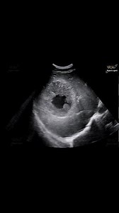 90K views · 1K reactions | This 36-year-old male, who has never consumed alcohol (non-alcoholic), has been experiencing persistent fever and upper abdominal pain and tenderness for the past 2 months. #radiology #RadiologyQuiz #ultrasoundscan #radiologylife #sonologist #diagnostics #sonography #radiologist #ultrasound #liverhealth #liverdisease #liverabscess #abscess #fever | Ultrasound report expert | Facebook