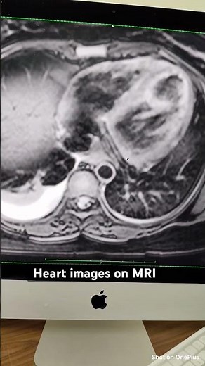 Explore Heart beating in MRI scan # radiology # MRI #test