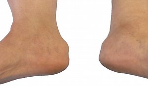 Retrocalcaneal Bursitis