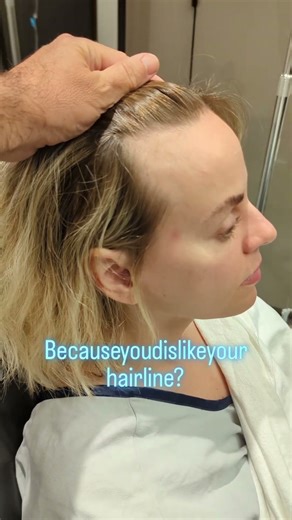 hairline lowering surgery also known as forehead reduction surgery using scalp advancement