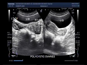 Ultrasound Video showing Another case of Polycystic ovary syndrome (PCOS).