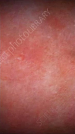 Lymphatic filariasis transmission into the blood: Animation.