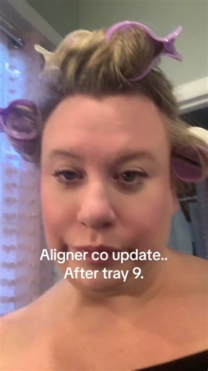 Aligner co update. Tray 9. #trayliner #invisalign #alignerco