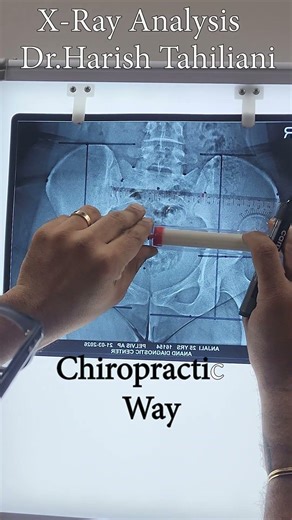 Pelvic X-Ray Analysis in Chiropractic | Body Tilt Ka Real Reason! #harishphysiotherapy