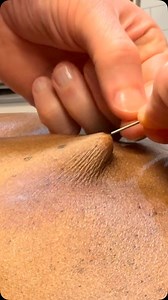 21 reactions · 3 comments | Dry needling helps release tight muscles...