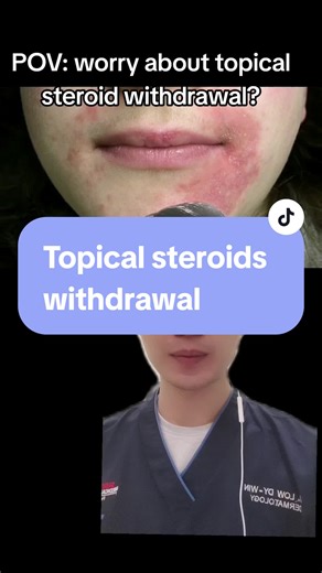 #FYP #fypviral #steroid #tsw #steroidphobia 1. Tacrolimus 2.pimecrolimus 3. Crisaborole #Dermatologist
