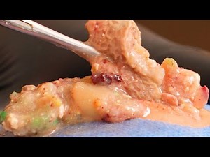 Dr. Lee 🌝 Two Super Cysts 🌝 Geoff Butler Enilsa MrPopZit 🌝 Dr. Pimple Popper 🌝 D261207