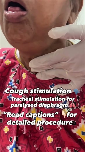 To stimulate the cough for secretion removal in paralysed diaphragm patients👇