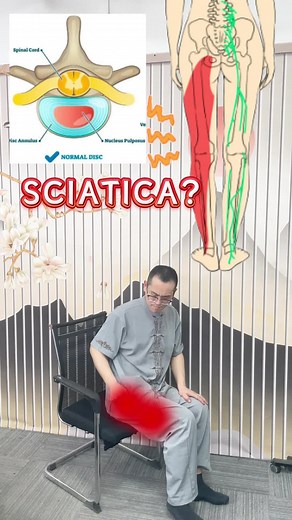坐骨神经痛的有效缓解方法