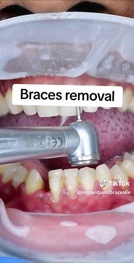 Exciting Braces Removal: Up Close on the Last Day