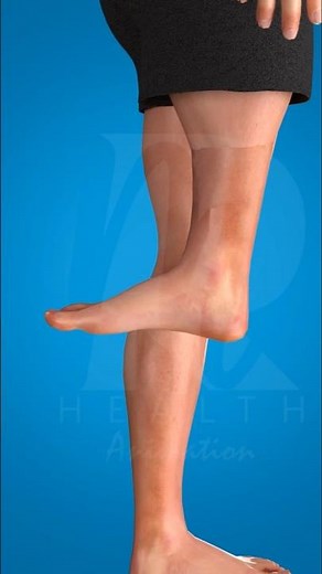 The Surgery That Turns Ankles Into Knees