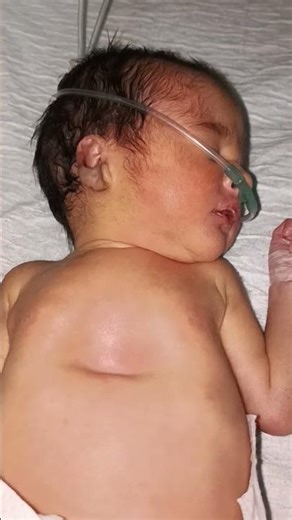 Pectus Excavatum in a Baby | Sunken Chest Condition #baby #newborncare
