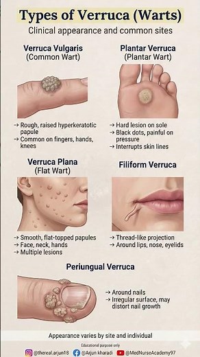 Types of Verruca (Warts) Explained | Common, Plantar, Flat, Filiform & Periungual Warts #fibrous