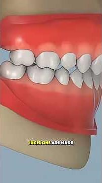How Bimaxillary Osteotomy Surgery Is Done (3D Animation) #maxillofacial#medical3d #3danimation
