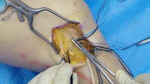 MCL Reconstruction With Gracilis Autograft, Knee FiberTak® Anchors, and InternalBrace™ Technique