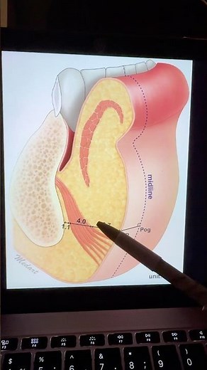 Как увеличить подбородок филлером ?