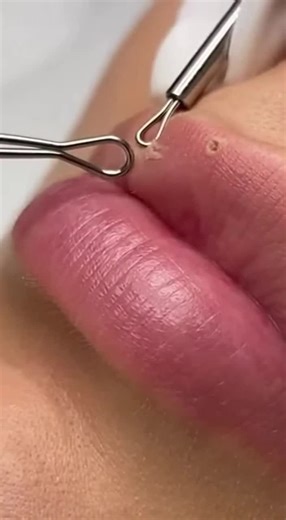 black heads remove for lips #foryou #facecleaning #creatorsearchinsights #faceclean #viral