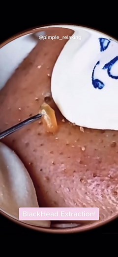🤤🤤🤤 #blackhead #satisfying #extractionsatisfaciton #pimplepop #acne