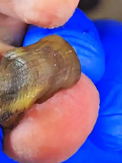 5.4K views · 56 reactions | Very thick toenails removal #longtoenails #thicktoenails #Ingrown #Pedicure #toenails #Toenailfungus #nail #cleannail #warts #cleaner #toenailremoval #ingrowntoenailremoval #fblifestyle Disclaimer: Videos do not show original ingrown nails,they are used for education purpose. Thank You,,, | RoBi Bro's | Facebook