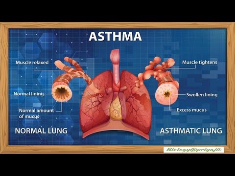 Asthma Simplified for Students | Causes, Diagnosis & Prophylaxis Explained Step by Step.