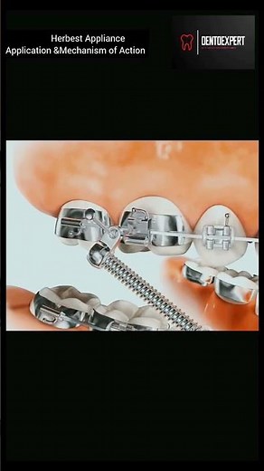 Orthodontic Herbst Appliance | Application & Mechanism of Action 🎬😑 #shorts #dentist #viral 🔥🔥👨‍⚕
