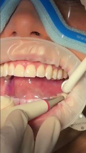 Guided Biofilm Therapy (GBT): The Future of Plaque Removal for a Healthier Smile | Rockwall, TX